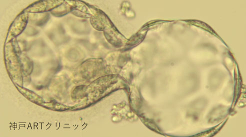 【図１】透明帯を破ってハッチング（孵化）しかけている胚盤胞